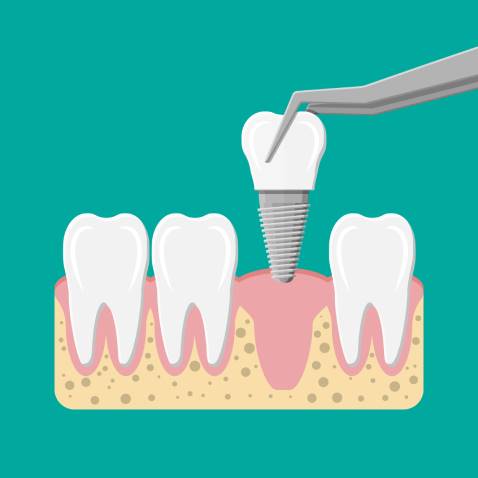 زراعة وتجميل الأسنان