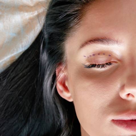  تجميل جفون العين